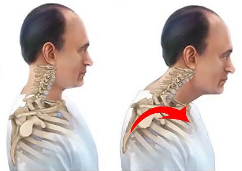 Coluna saudável e doente