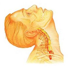 Osteocondrose da coluna cervical