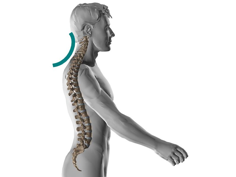 Osteocondrose cervical da coluna vertebral, causando muitos sintomas desagradáveis